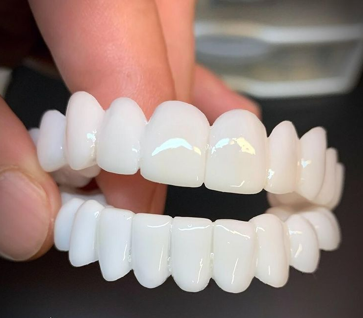 Glevato | DentAlign Dental Veneers – Natural Fit and Comfort