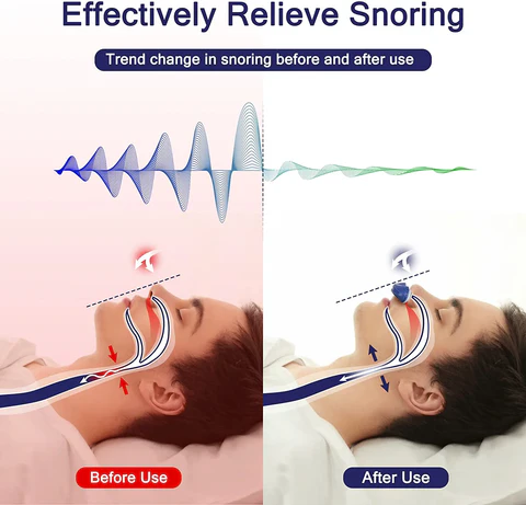 Glevato | Micro CPAP Anti-Snoring Device | Maskless Sleep Apnea Treatment