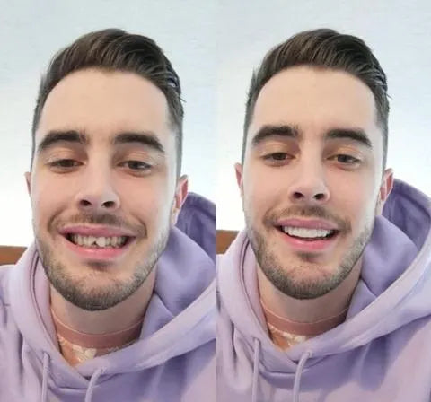 Glevato | On Smile Veneers (Upper and Lower Jaw included)