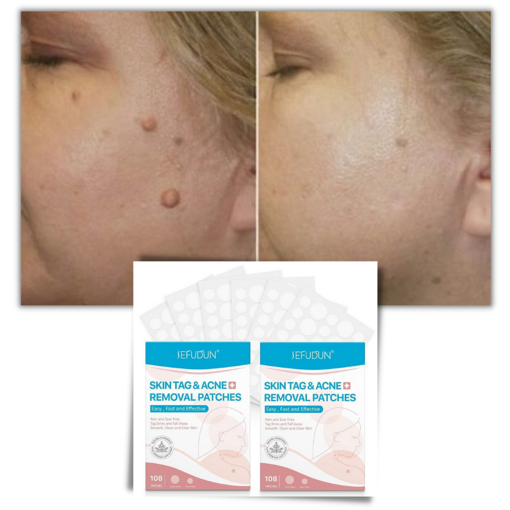 Glevato | Skin Patch - Remove Moles and Warts Naturally!