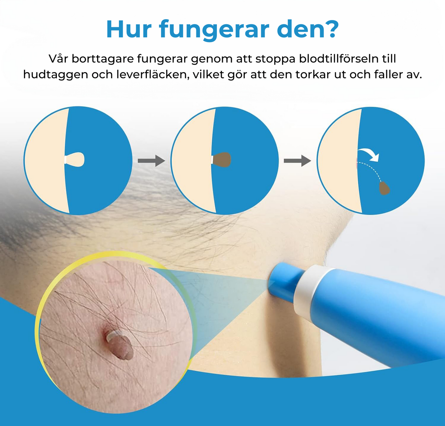 Liver Spot Removal - Removal of Moles