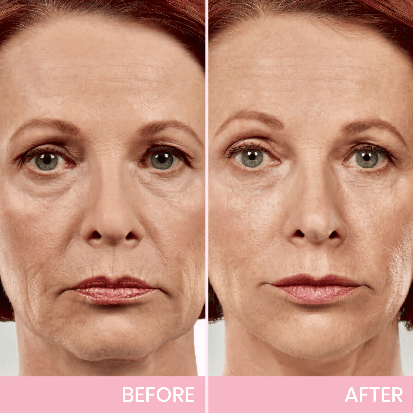V Face-Lifting Invisible Tape